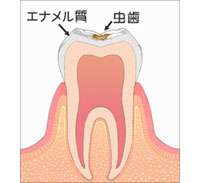 虫歯 C1