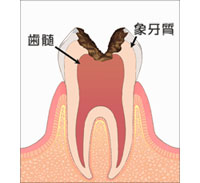 虫歯 C3