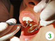歯周ポケットの深さを調べることで、歯周病の進行具合を確認します。