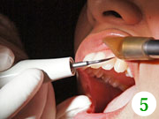 プラークや歯石を、専用の道具を使ってきれいに除去します。